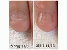 噛み爪を辞めたい、、、