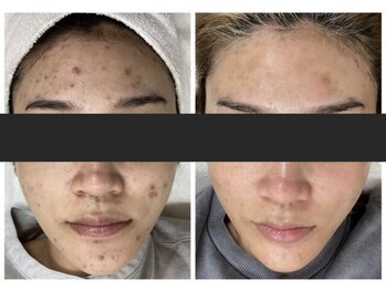 エアリアル 玉名店/ハーブピーリングbeforeafter