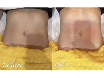 テンディ(TenD.)/キャビ×ラジオ派×EMS吸引 1回