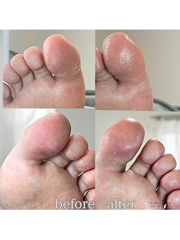 フットミー(foot mii)/親指の逆剥け