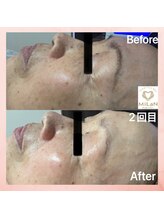 ミラン(MiLaN)/毛穴洗浄/ハイドラヴィーナス