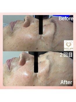 ミラン(MiLaN)/毛穴洗浄/ハイドラヴィーナス