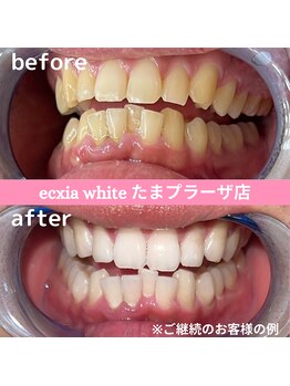 エクシアホワイトニング たまプラーザ店/ビフォーアフター