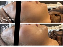 ビノスビューティー(vinos.beauty)/韓国から上陸！脂肪分解