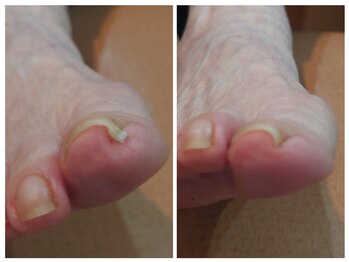 アンティ(Aunty)/巻き爪補正(GF補強正法)