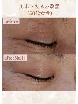 スリーエッセンス(3THREE ESSENCE)の写真/目元・口元のシワ/顔全体のたるみ/開いてしまった毛穴/頬のシミなどにアプローチ!１トーン明るい輝く肌に◎