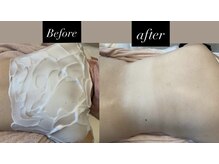 敏感肌専科・眠れる美肌脱毛Amitie札幌琴似店〈顔脱毛/毛穴洗浄/フェイシャル〉/背中　毛穴洗浄×脱毛