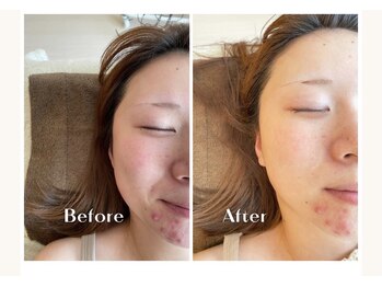 キラリ(Kirari)/【美肌エステ月2・2ヶ月継続】