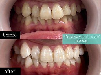 ホワイトニングカフェ 博多駅前店(WhiteningCafe)/◎歯のホワイトニング施術写真◎