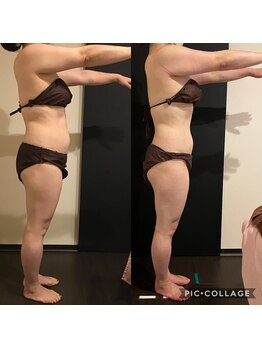 リンネ(Linne)/ビフォーアフター