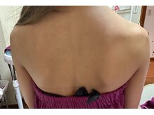 スキンケアスタジオ アコ 新宿店(Aco)/背中キャビテーションラジオ波前