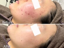 ニキビ研究所 浦和店/思春期ニキビ・大人ニキビケア