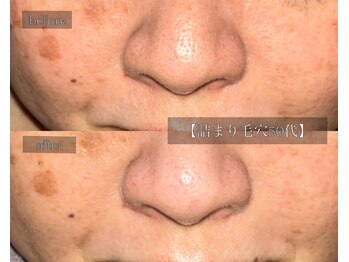 ル シーニュ/詰まり・うぶ毛詰まり 50代