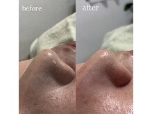 ムスビ(Musubi)/毛穴洗浄　Before After