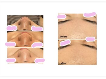 バニーヒップ(Bunny Hip)/カーボキシー