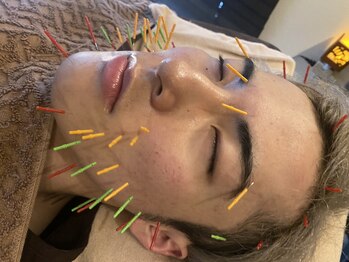 リノア鍼灸院(LINOA)/メンズ美容鍼☆小顔や肌荒れに!