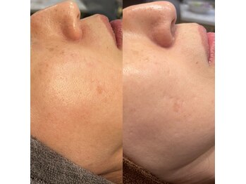 モルセラ(Moluccella)/10回の施術