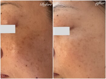 美バストアルファ(美bust α)/【シミケア】症例