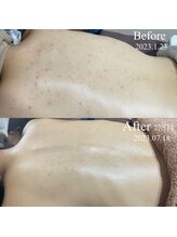 ラ ジェム(la gemme)/背中ニキビケア