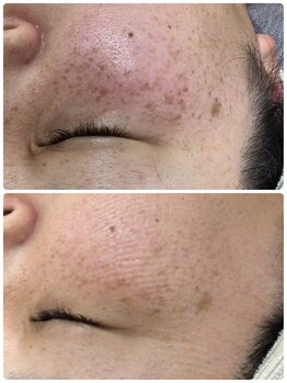 アルカンジュ(Archange)/オセロ+デトックス〈シミ改善〉