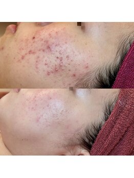 クオルーチェ(CuoLuce)/REVI陶肌トリートメント