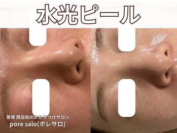 ポレ サロ(pore salo)/【水光ピール｜赤み｜くすみ】