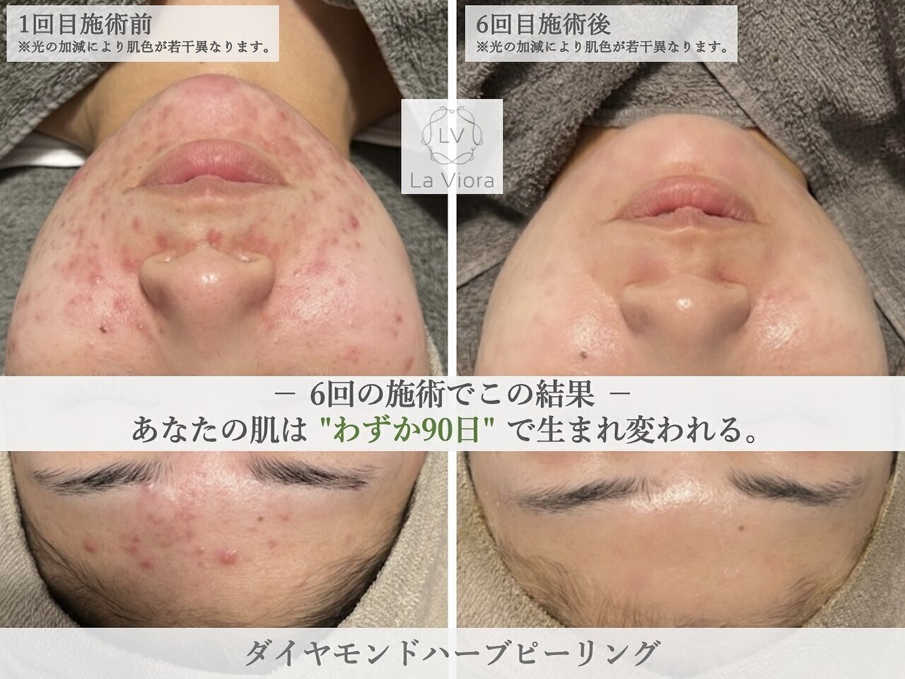 エルブイ 江坂(LV)｜ホットペッパービューティー