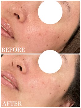 ヴィヴフォー(VIV for)/毛穴改善にも!