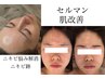 （ニキビのお悩み）セルマンにて肌改善　¥22000→¥11000