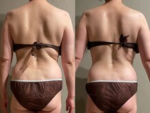 メロウ(me: llow)/ハイパーナイフEX/恵比寿エステ