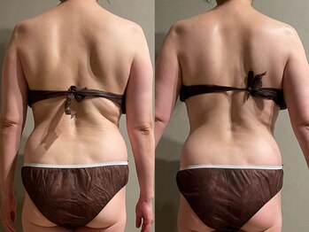 メロウ(me: llow)/ハイパーナイフEX/恵比寿エステ