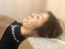 こじま 富雄団地接骨院/美容鍼