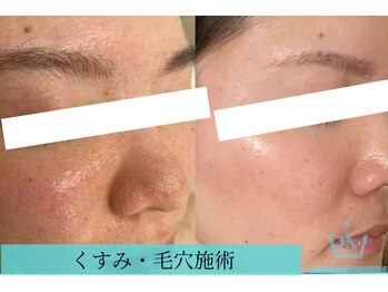 リメイクビューティークリニック(REMAKE BEAUTY CLINIC)/毛穴撲滅