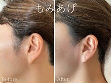 シエナ(ciena)/シュガーリング顔症例写真♪