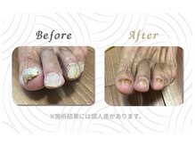 フットプロ 上田/分厚い爪