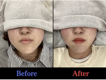 ブルーム(Bloom)/小顔矯正(6回変化)