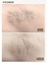 オーキッド(ORCHID)/キッズ脱毛