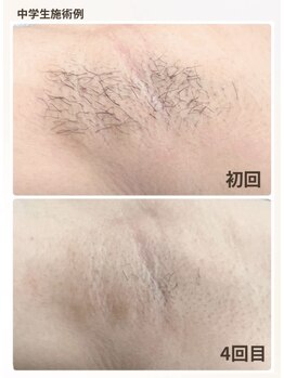 オーキッド(ORCHID)/キッズ脱毛