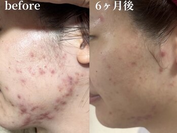 フォー(For...)の写真/天王寺の高評価!!毛穴ケアサロン｜皮脂/開き/黒ずみ根本ケア◎天然ハーブ×高密度超音波で新毛穴ケアも◎