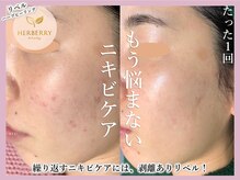 ハーバリー ハーブピーリング 大阪梅田店(HERBERRYハーブピーリング)/ハーブピーリング専門店HERBERRY