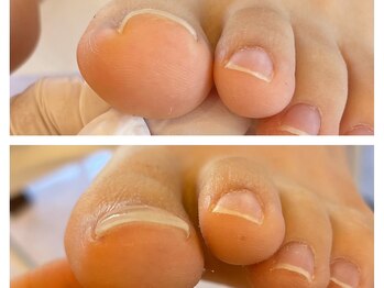 キラネイル アンド アイラッシュ by World Beauty(KIRA)/巻爪補正 ペディグラス