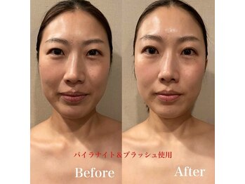 ハミル 平尾店(HAMIL)/パイラナイト《before・after》