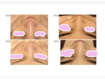 バニーヒップ(Bunny Hip)/カーボキシー