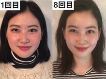 ミヌレ 大阪店(minulle)/回数を重ねるとこんなに変わる