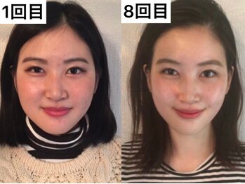 ミヌレ 大阪店(minulle)/回数を重ねるとこんなに変わる