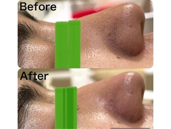 マスカレード 品川(Masquerade)/【症例写真】施術1回