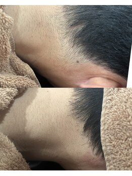 アカラ 読谷店(AKALA)/えりあし脱毛