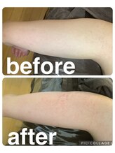 ギンザアール(GINZA R.)/二の腕に徹底アプローチ◎