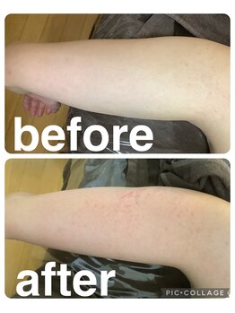 ギンザアール(GINZA R.)/二の腕に徹底アプローチ◎