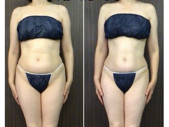 バーテックスキー(Vertexkey)/お腹シェイプ 施術5回の途中経過